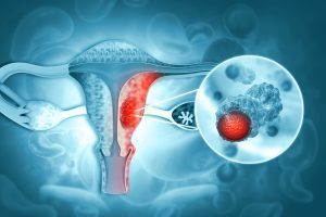 Best Practices for the diagnosis and staging of endometrial cancer