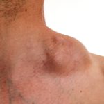 Beyond ABVD: Targeted agents and strategies in first line treatment of elderly Hodgkin Lymphoma patients