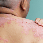 Biologic therapy in dermatology practice today