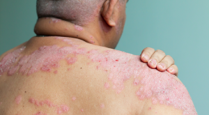 Biologic therapy in dermatology practice today