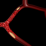 VTE treatment across the continuum – Practical pathways for acute, extended and peri-operative anticoagulation management