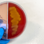 Module 1: Vaccine-Preventable Pneumonia Series: Not so sweet! Capsular polysaccharide type 3 and pneumococcal disease
