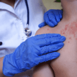 Clinical Update – Chronic urticaria in South Africa