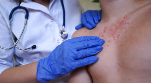 Clinical Update – Chronic urticaria in South Africa